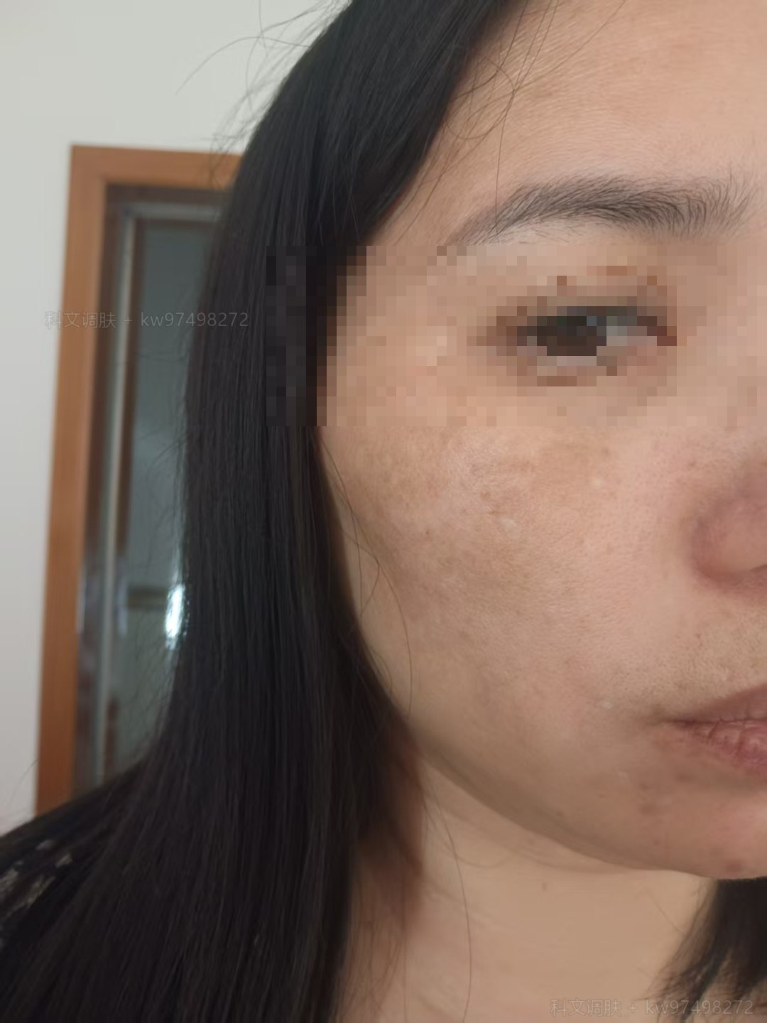 调理后：左脸3个半月基本改善（眼部已脱敏）
