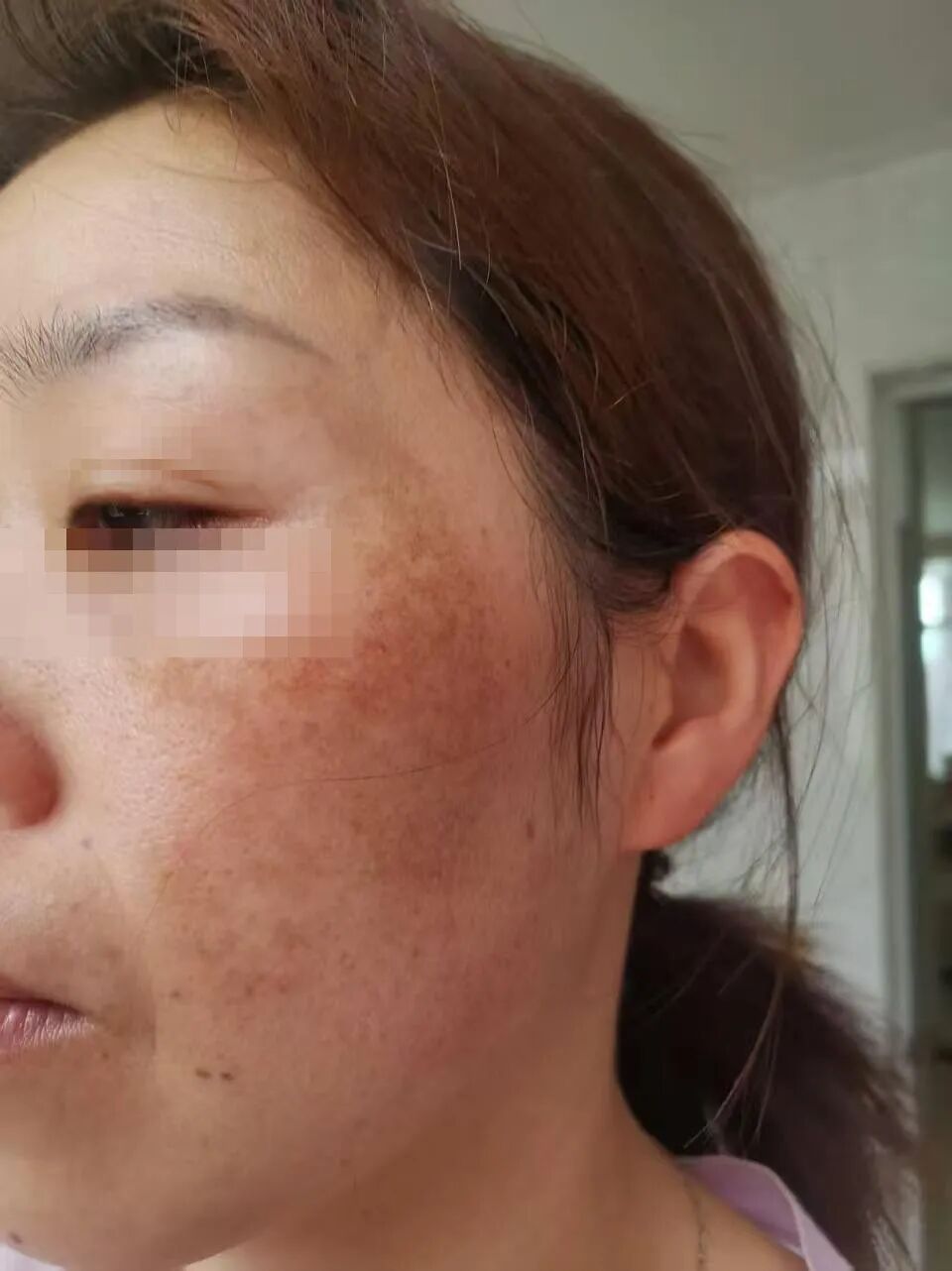 调肤前的皮肤状态，色沉连片、发红发暗